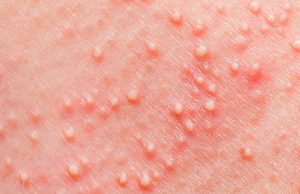 10 Most Effective Home Remedies To Treat Heat Boils on Skin