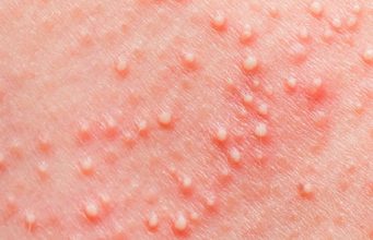 10 Most Effective Home Remedies To Treat Heat Boils on Skin