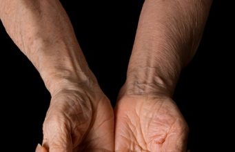How to Get Rid of Wrinkles From Hands?