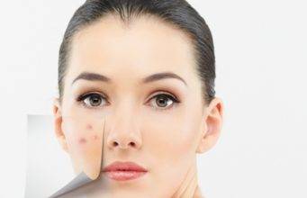 Top 10 Best Antibiotics For Acne And Pimples Treatment