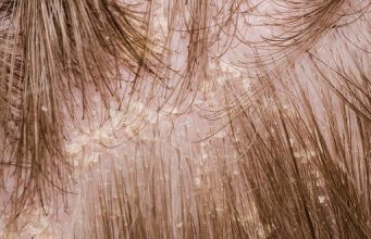 5 Easy Ways to Prevent Flaky Scalp