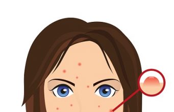 Ayurvedic Treatments for Pimples (Acne) – 10 Ingredients That Work!