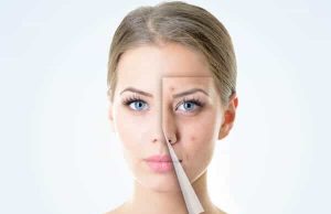 How To Use Multani Mitti For Pimples (Acne)?